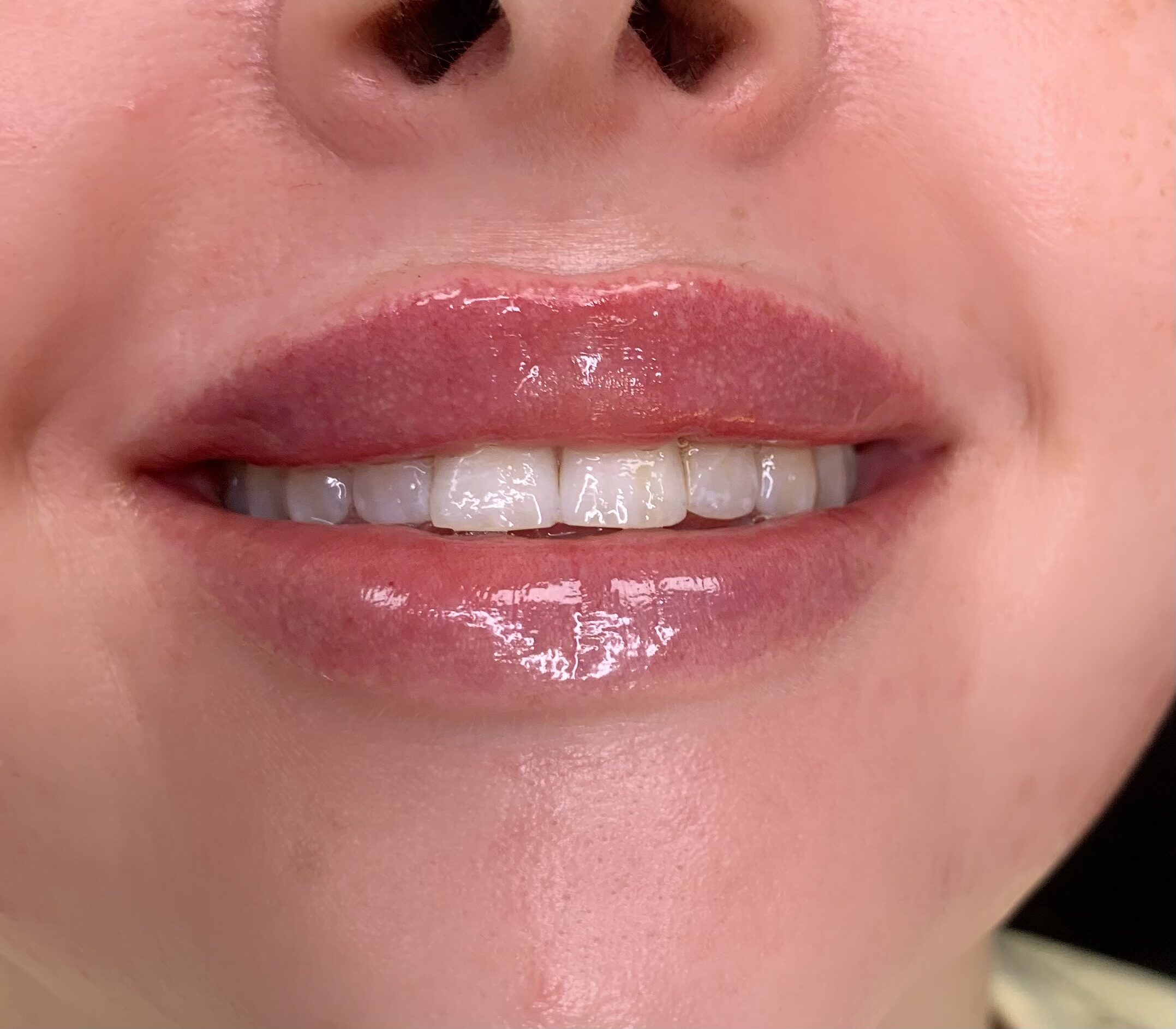 Lippen Hyaluron