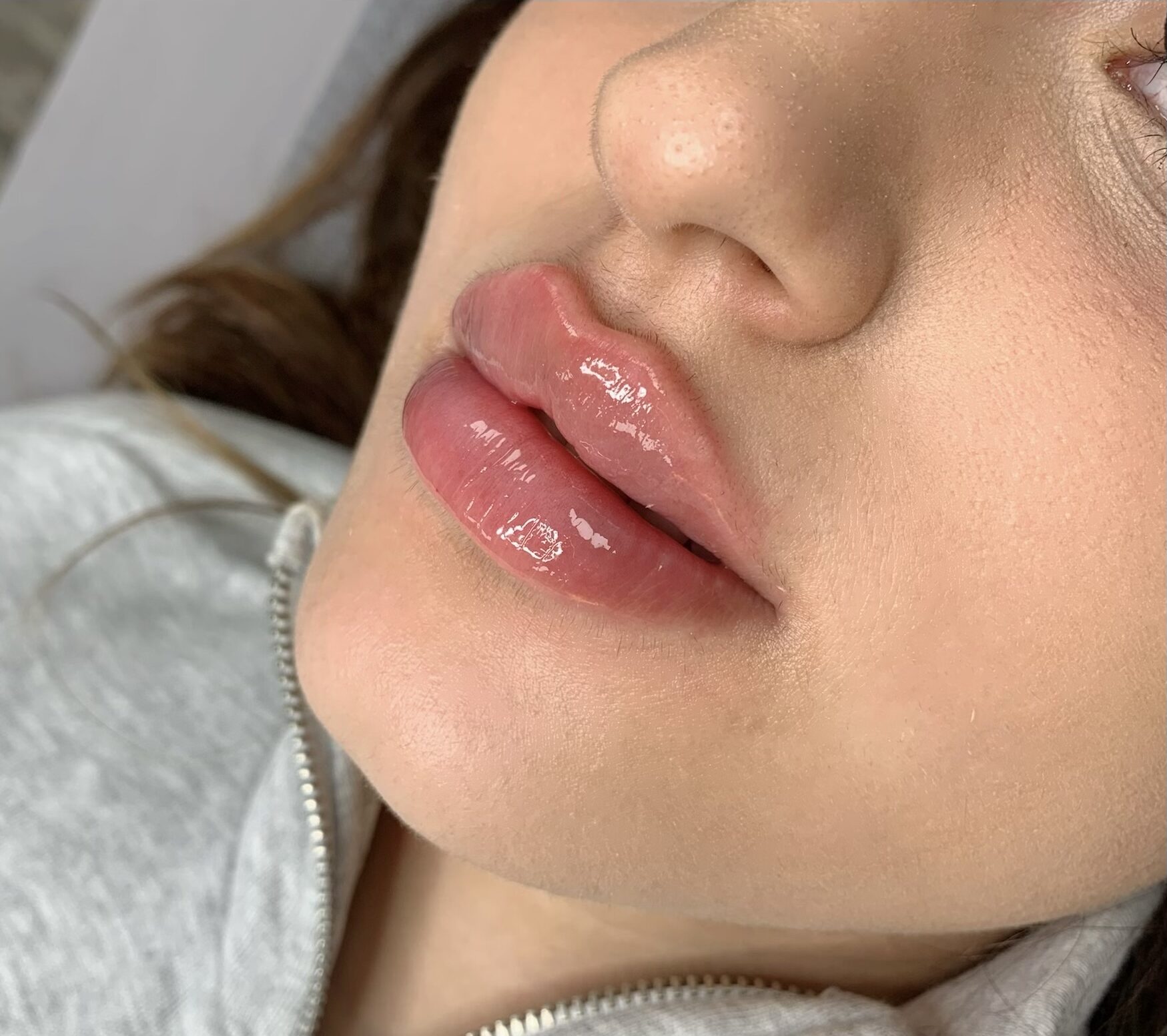 lippen-aufspritzen-bielefeld