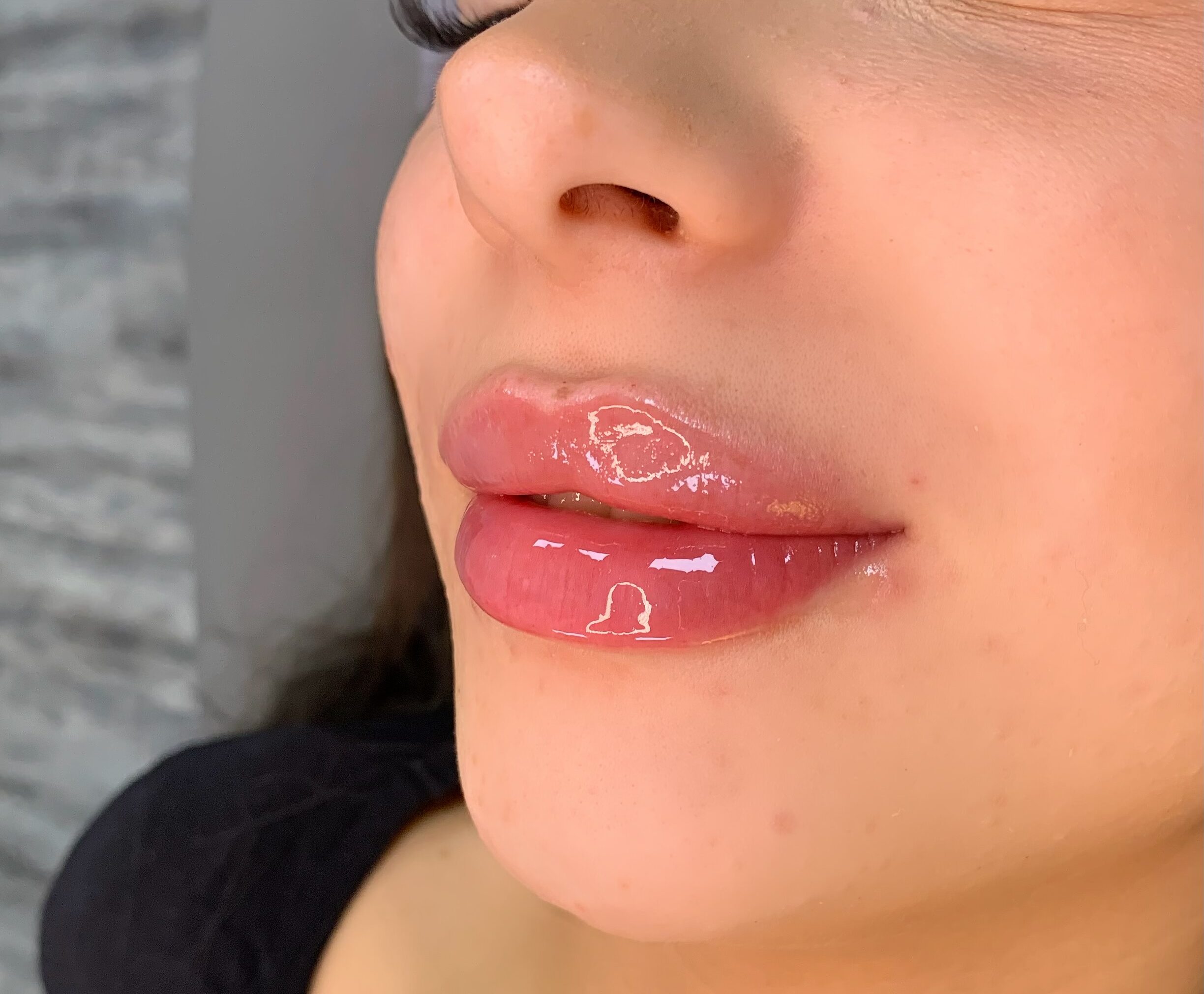 Lippen aufspitzen mir Hyaluron