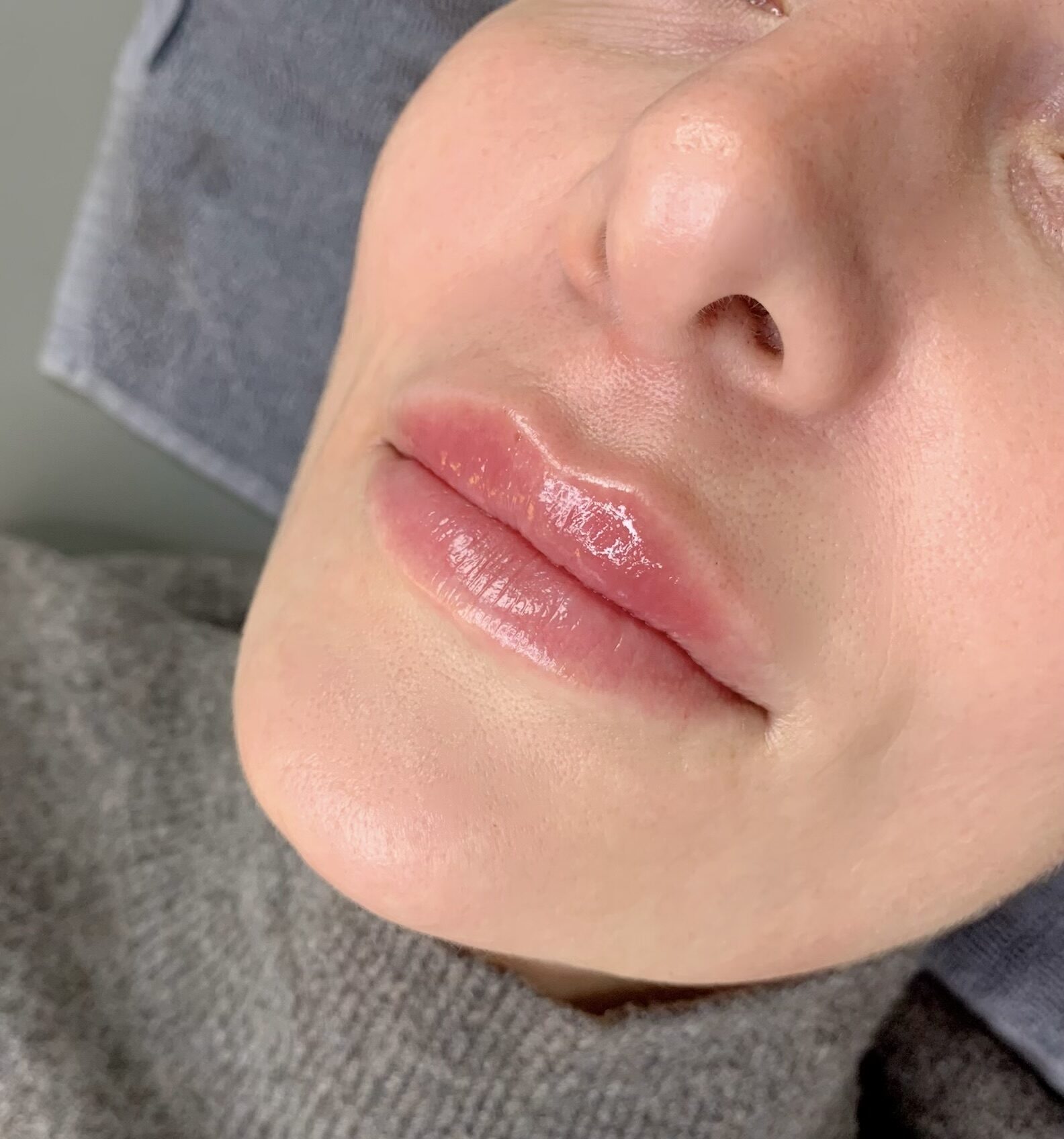Lippen aufspritzen natürlich