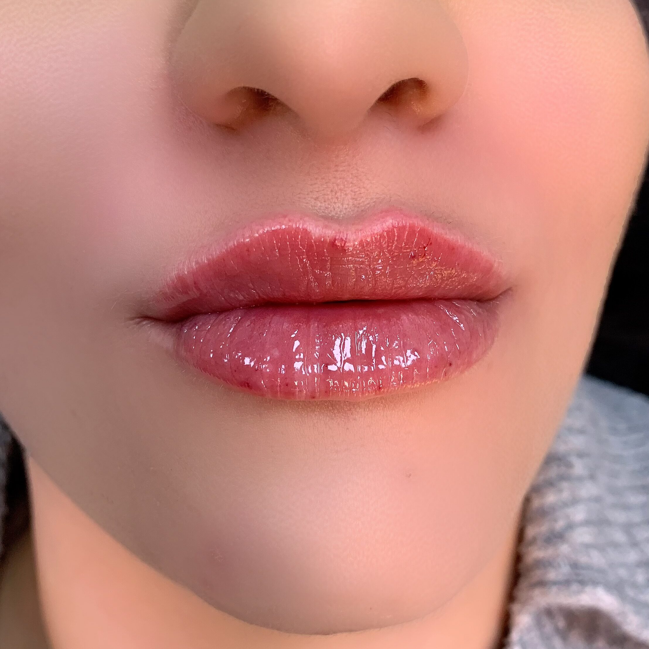 Lippen aufspritzen preise