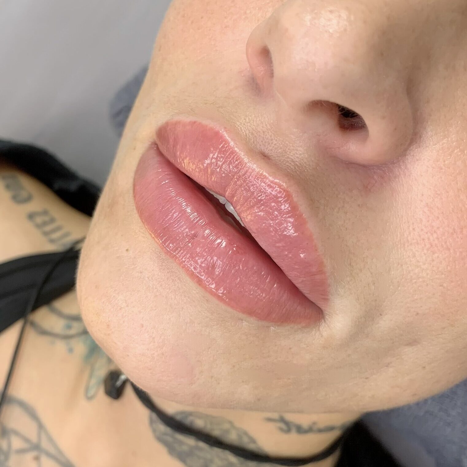 volle Lippen mit Hyaluron
